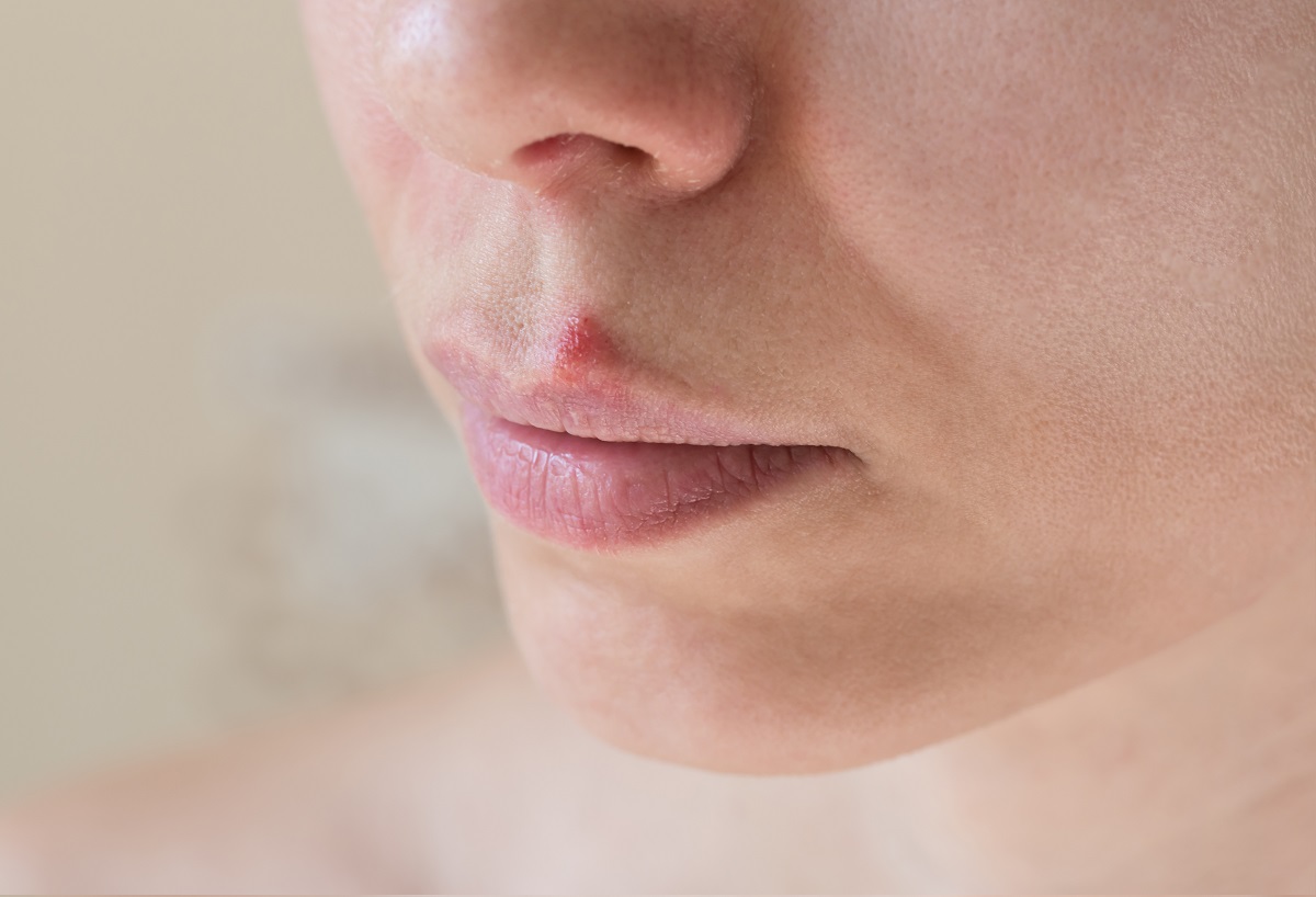 Herpes labial: ¿qué es y por qué aparece?